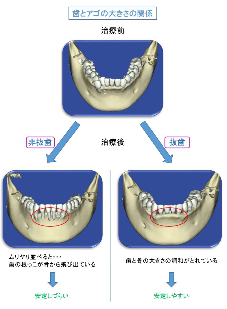 矯正治療について（歯を抜くの？抜かないの？） | 福岡 矯正歯科｜MOTO