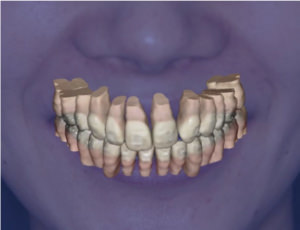 実際の患者様の写真に現在の歯の様子を合成。